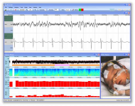 g.FEATUREmonitor, Cerebral Function Monitor for clinical research